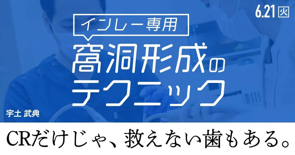 【インレー専用】もう迷わない、窩洞形成のテクニック - 明日から自信を持って形成ができるようになります。