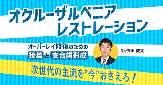 オクルーザルベニアレストレーション