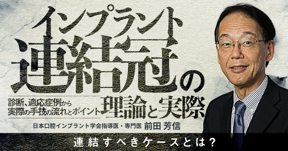 インプラント連結冠の理論と実際 - 診断、適応症例から実際の手技の流れとポイント