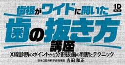 歯根がワイドに開いた歯の抜き方講座