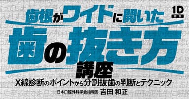 歯根がワイドに開いた歯の抜き方講座