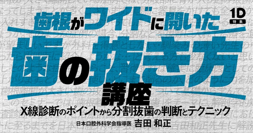 歯根がワイドに開いた歯の抜き方講座
