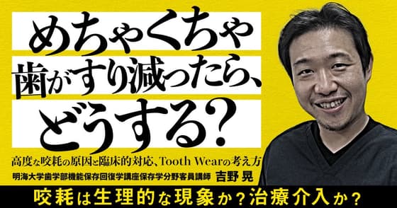 めちゃくちゃ歯がすり減ったら？重度の咬耗症はどう対応する？バイトプレートを使って治療する？
