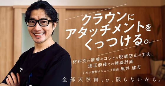 クラウンにアタッチメントをくっつける。