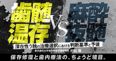 「歯髄温存」vs「麻酔抜髄」