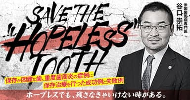  SAVE THE "HOPELESS" TOOTH