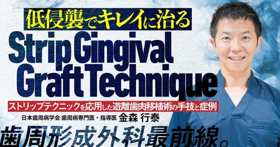 低侵襲でキレイに治る「Strip Gingival Graft Technique」