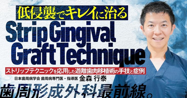 低侵襲でキレイに治る「Strip Gingival Graft Technique」