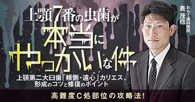 上顎7番の虫歯が本当にやっかいな件。