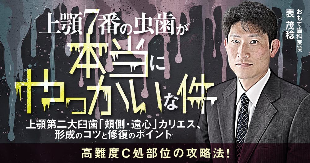 上顎7番の虫歯が本当にやっかいな件。 - 上顎第二大臼歯「頬側・遠心」カリエス、形成のコツと修復のポイント