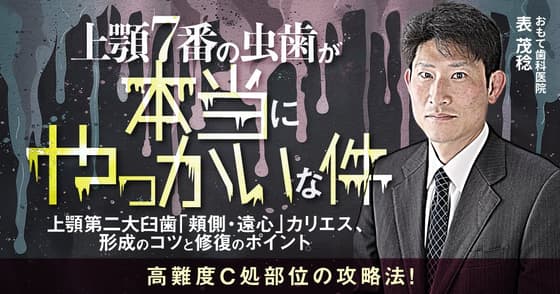 上顎7番の虫歯が本当にやっかいな件。