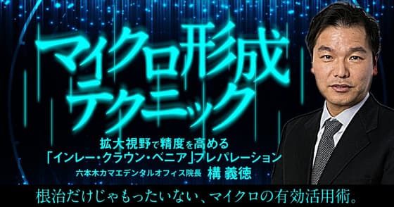 マイクロ形成テクニック