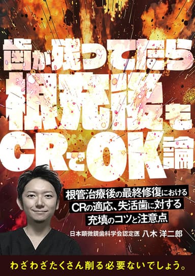 ランキング8位の歯が残ってたら根充後もCRでOK論