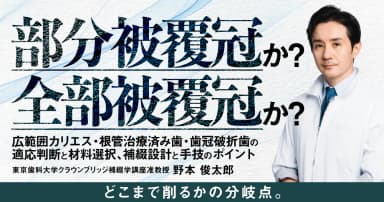 部分被覆冠か？全部被覆冠か？