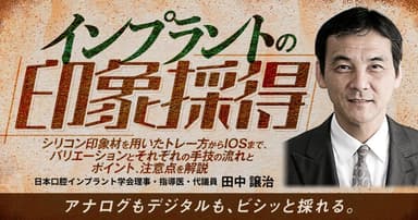 インプラントの印象採得