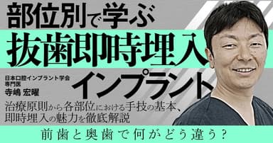 部位別で学ぶ「抜歯即時埋入」インプラント