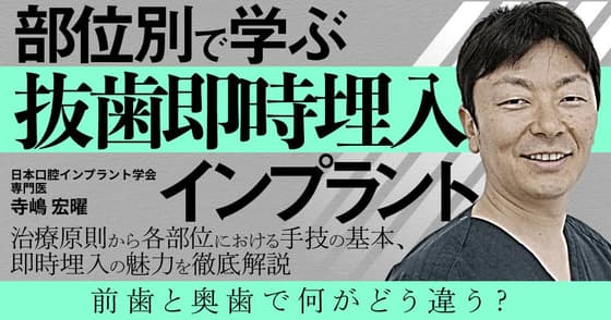 部位別で学ぶ「抜歯即時埋入」インプラント