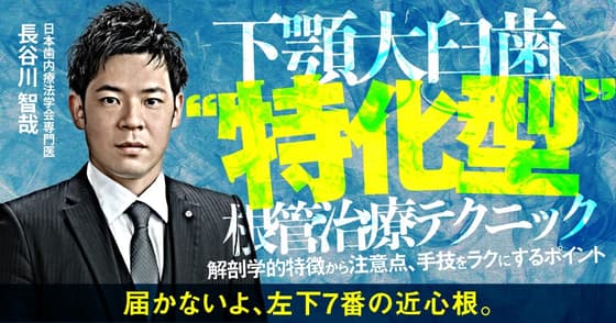下顎大臼歯”特化型”根管治療テクニック
