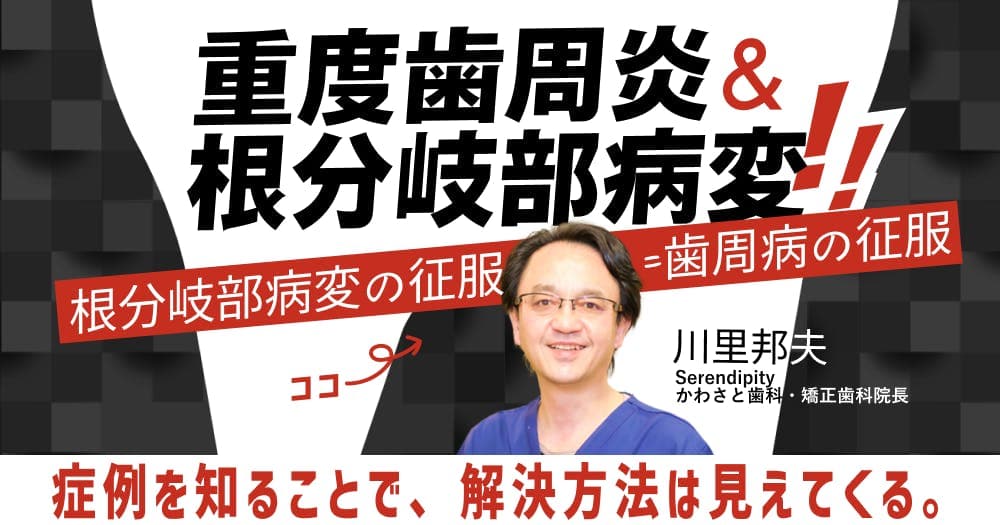 【再放送】重度歯周炎&根分岐部病変の臨床 - 根分岐部病変を制する者は、歯周炎を征する。