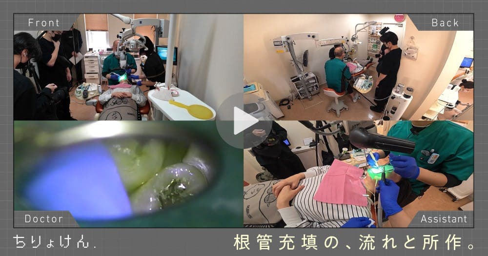 【治療見学】根管充填（上顎右側第二小臼歯）