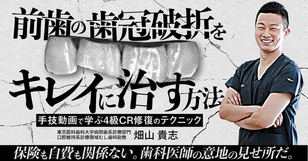 前歯の歯冠破折をキレイに治す方法