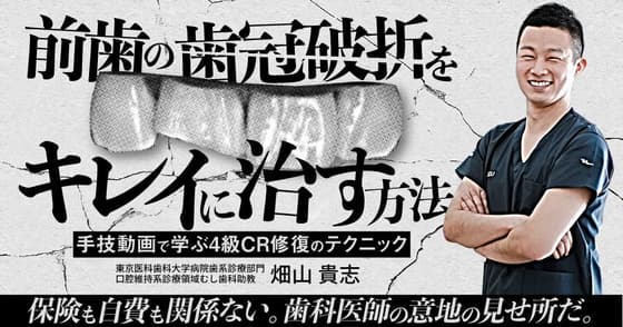 前歯の歯冠破折をキレイに治す方法