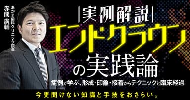 【実例解説】エンドクラウンの実践論