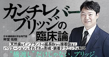 カンチレバーブリッジの臨床論