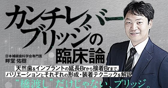 カンチレバーブリッジの臨床論