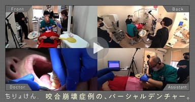 【治療見学】義歯調整