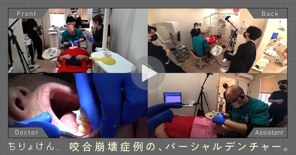 【治療見学】義歯調整 - 咬合崩壊症例における部分床義歯の調整