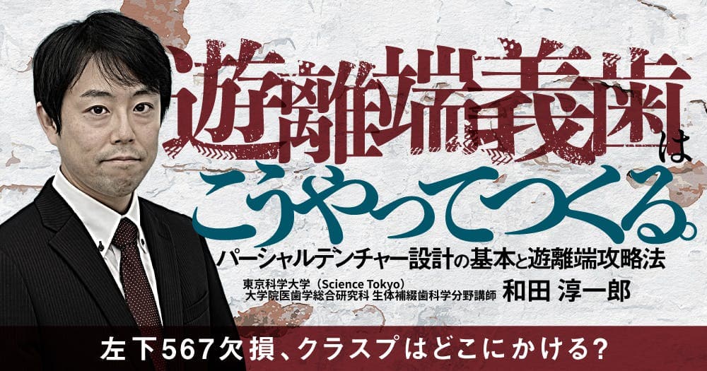 遊離端義歯はこうやってつくる。