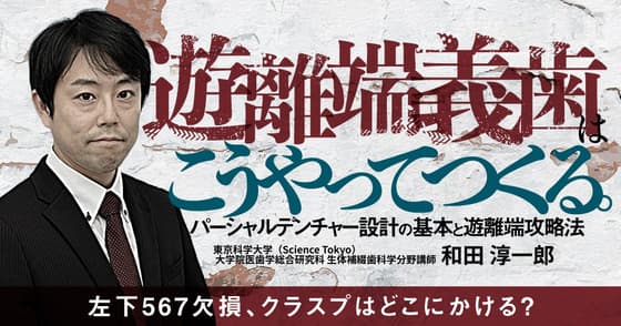 遊離端義歯はこうやってつくる。