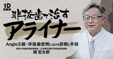 非抜歯で治すアライナー