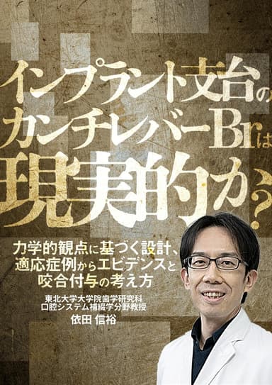 ランキング9位のインプラント支台のカンチレバーBrは現実的か？