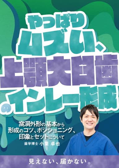 ランキング8位のやっぱりムズい、上顎大臼歯のインレー形成