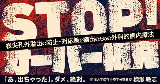 STOP！オーバー根充