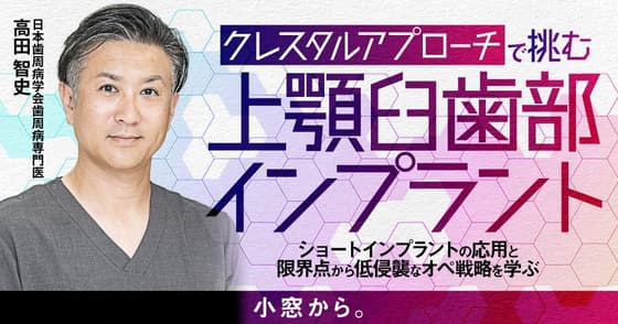 「クレスタルアプローチ」で挑む上顎臼歯部インプラント