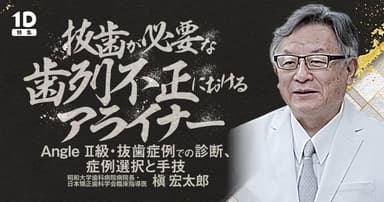 抜歯が必要な歯列不正におけるアライナー