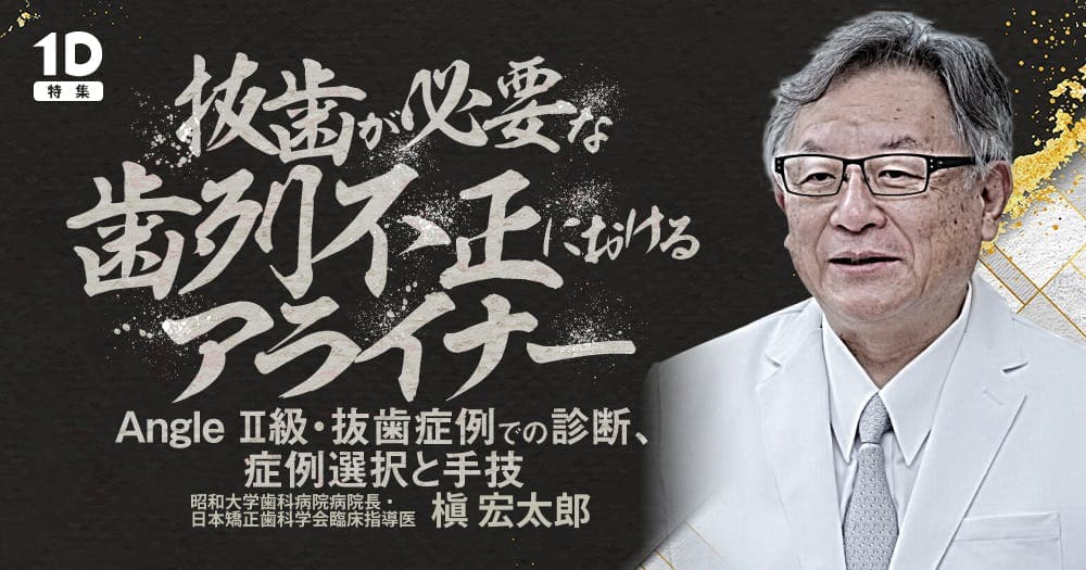 抜歯が必要な歯列不正におけるアライナー