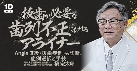 抜歯が必要な歯列不正におけるアライナー
