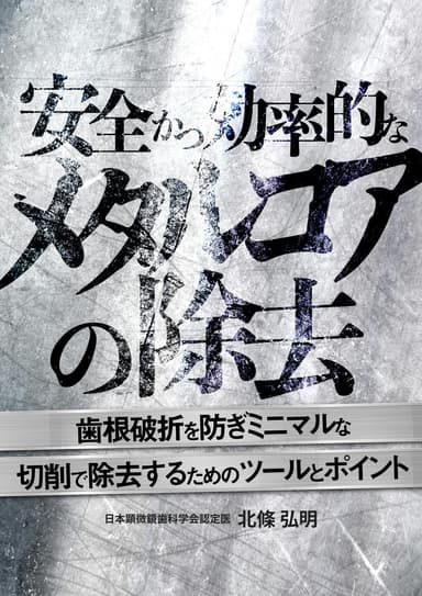ランキング12位の安全かつ効率的なメタルコアの除去
