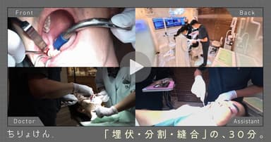 【治療見学】埋伏智歯抜歯（下顎右側第三大臼歯）