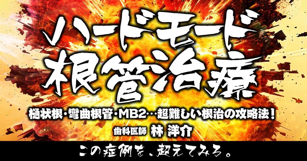 ハードモード根管治療 - 樋状根・彎曲根管・MB2…超難しい根治の攻略法！