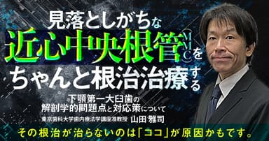 見落としがちな「近心中央根管（MMC）」をちゃんと根管治療する