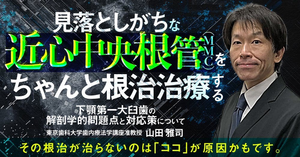 見落としがちな「近心中央根管（MMC）」をちゃんと根管治療する - 下顎第一大臼歯の解剖学的問題点と対応策について