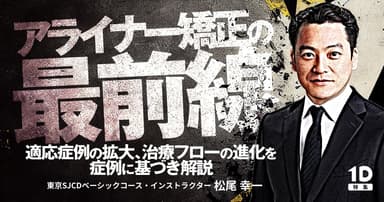 アライナー矯正の最前線