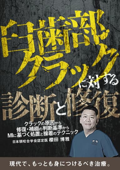 ランキング6位の臼歯部クラックに対する診断と修復