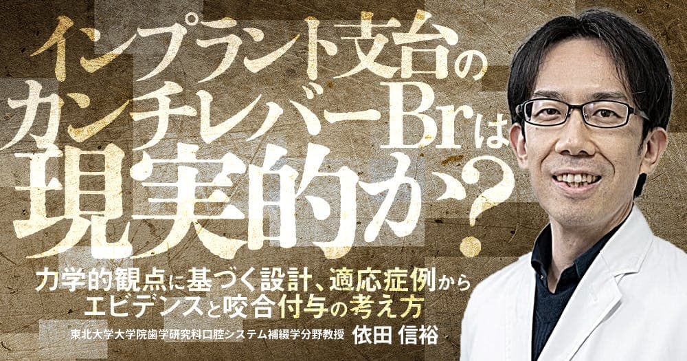 インプラント支台のカンチレバーBrは現実的か？ - 力学的観点に基づく設計、適応症例からエビデンスと咬合付与の考え方