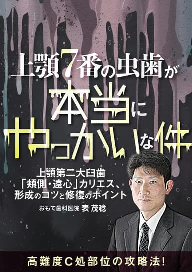 ランキング14位の上顎7番の虫歯が本当にやっかいな件。